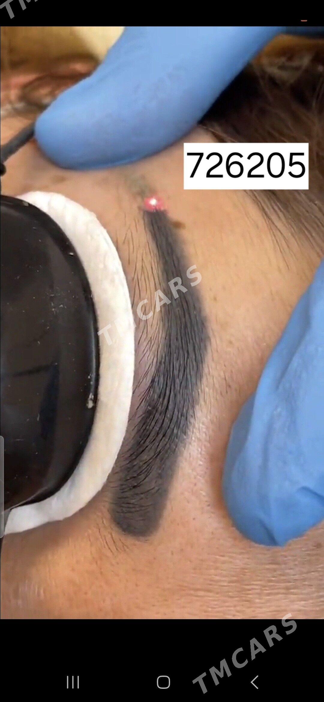 Permanent Tatu Ayyrmak Lazer - Ашхабад - img 4