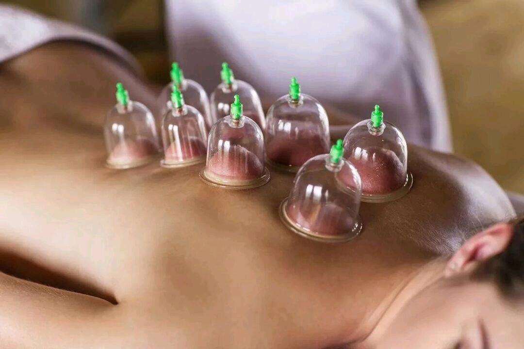 Hijama bankalar - Daşoguz - img 9