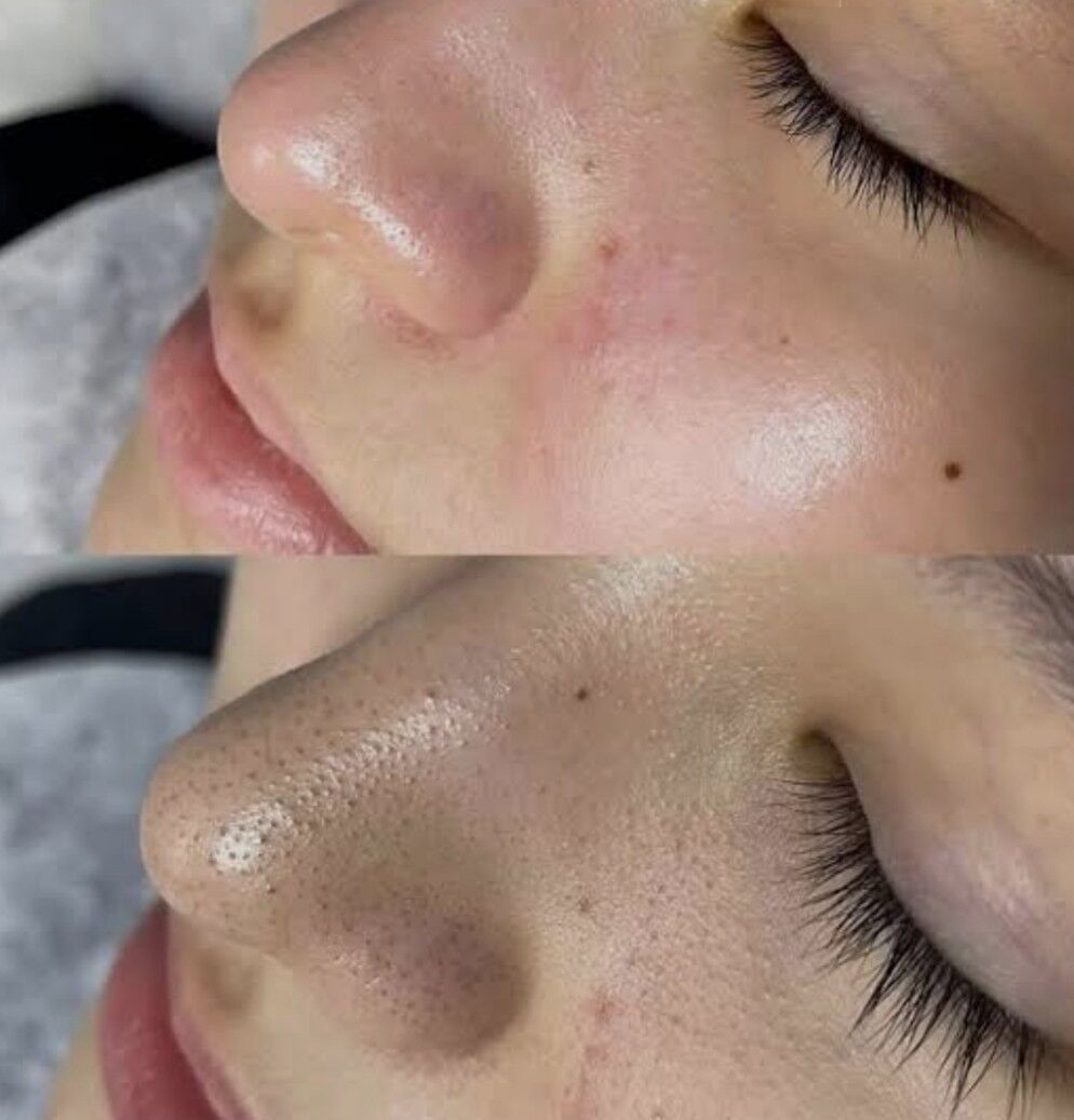 yuz acistka - 2 мкр - img 5