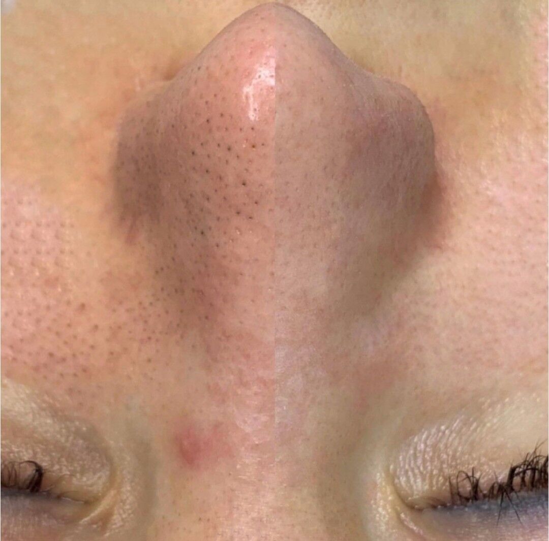 yuz acistka - 2 мкр - img 4