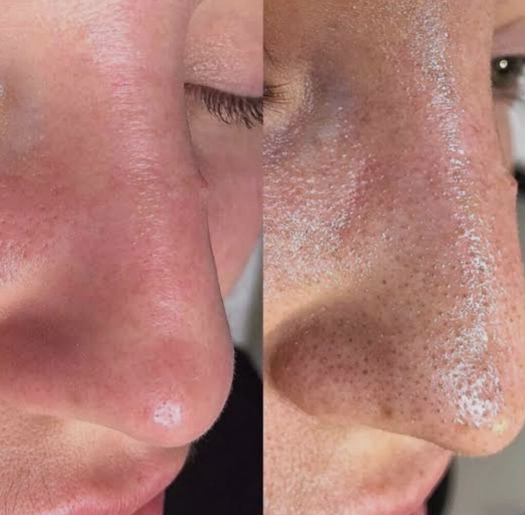 yuz acistka - 2 мкр - img 3