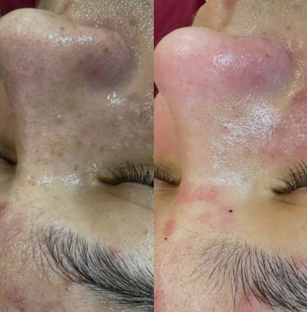 yuz acistka - 2 мкр - img 8