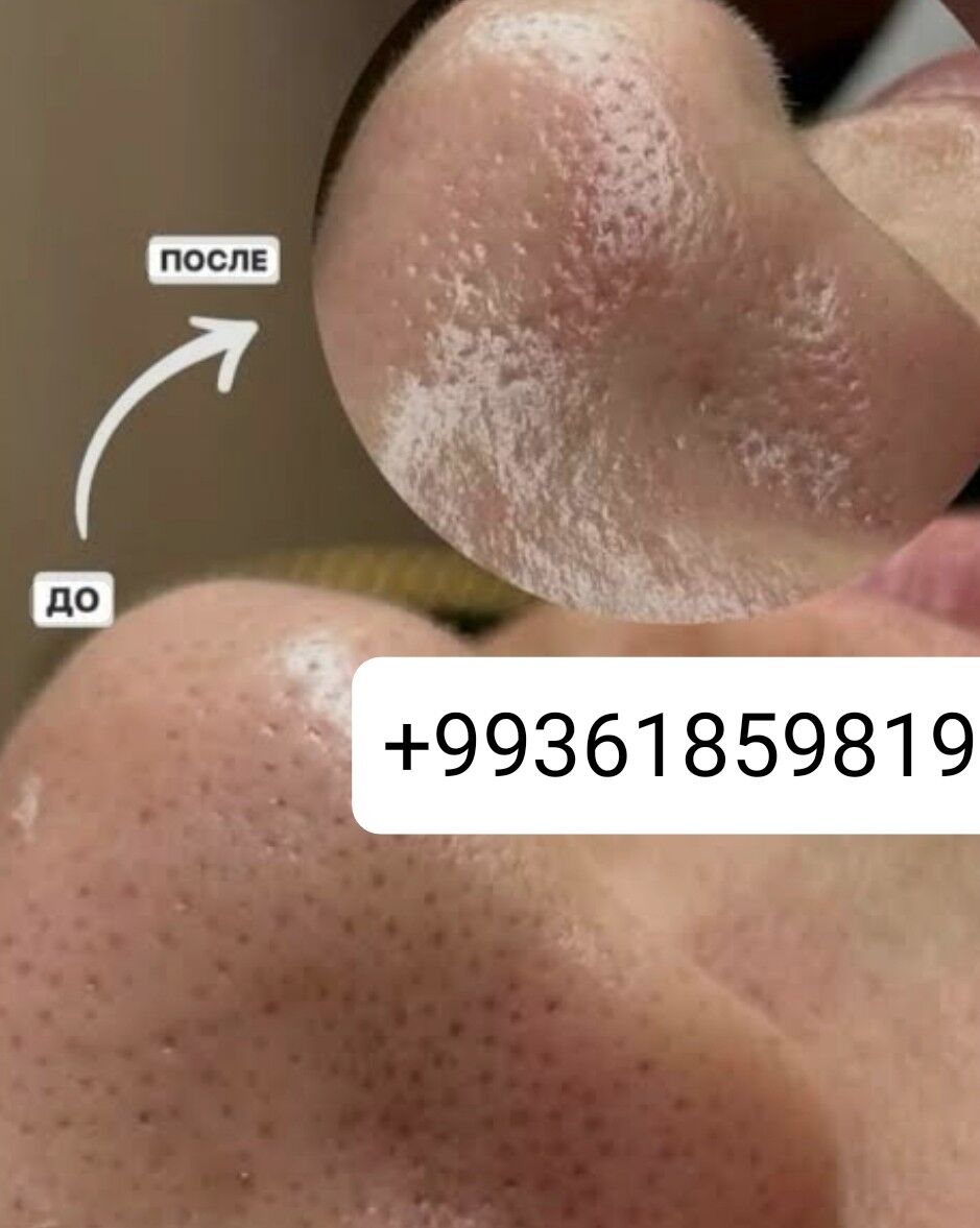 yuz acistka - 2 мкр - img 7