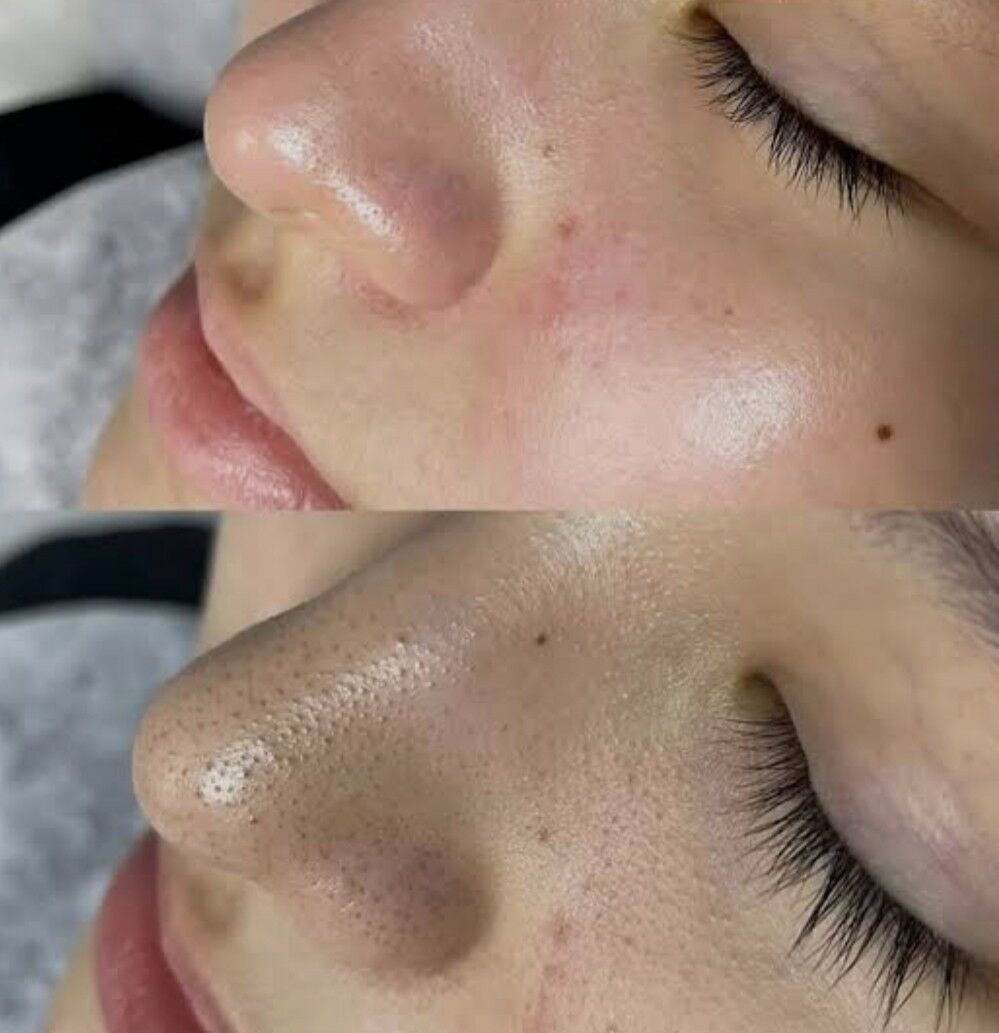 yuz acistka - 2 мкр - img 6