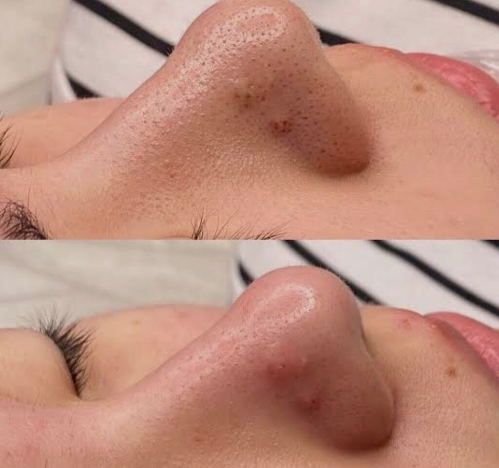 yuz acistka - 2 мкр - img 9