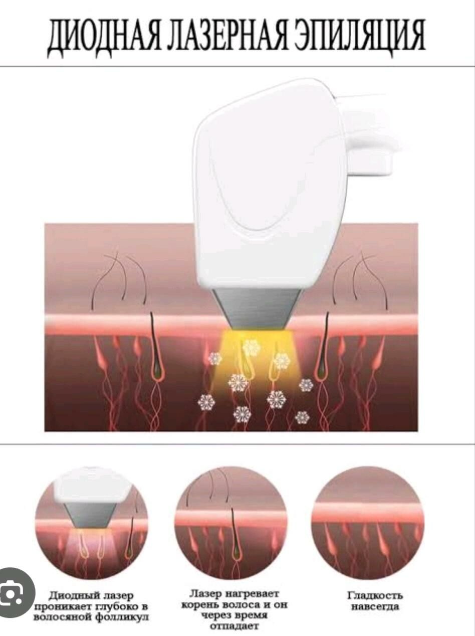 Lazerni epilatsiya - Ашхабад - img 1