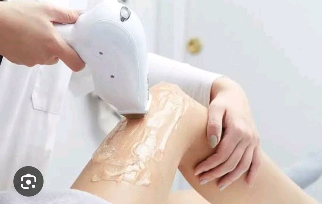 Lazerni epilatsiya - Ашхабад - img 2