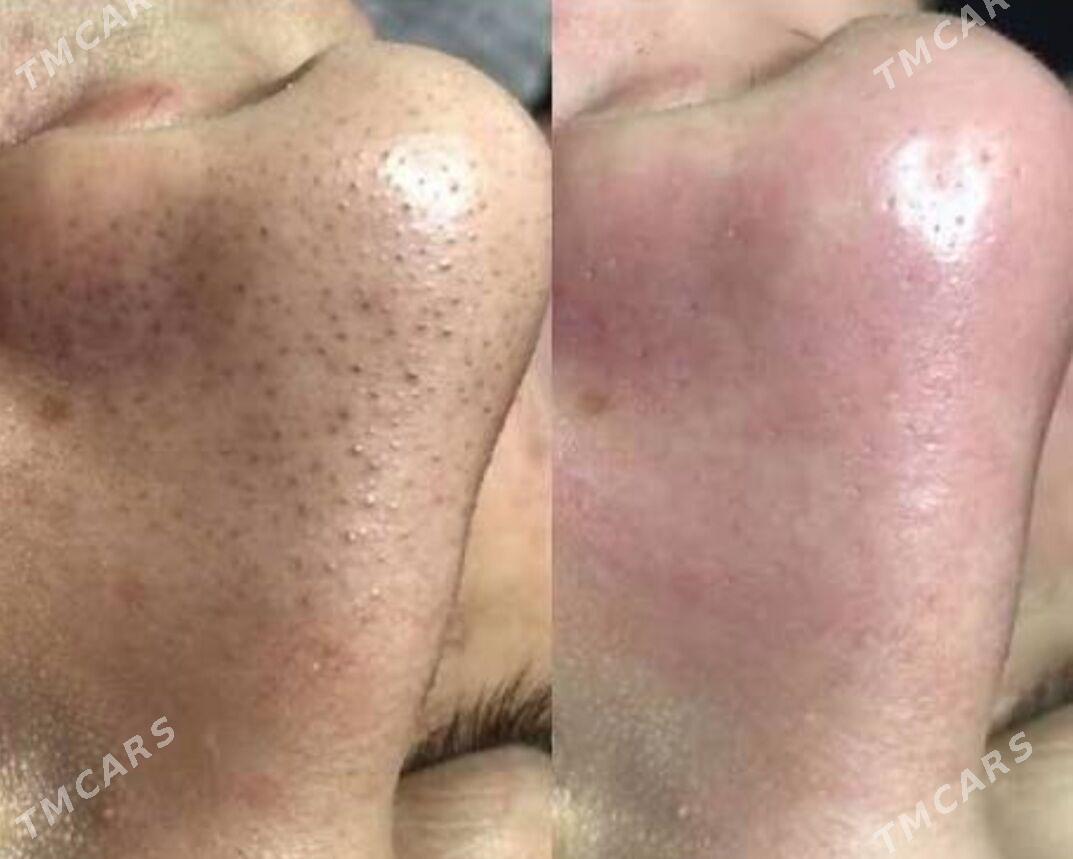 kirpik yuz cistka depilyatsa - Ашхабад - img 3