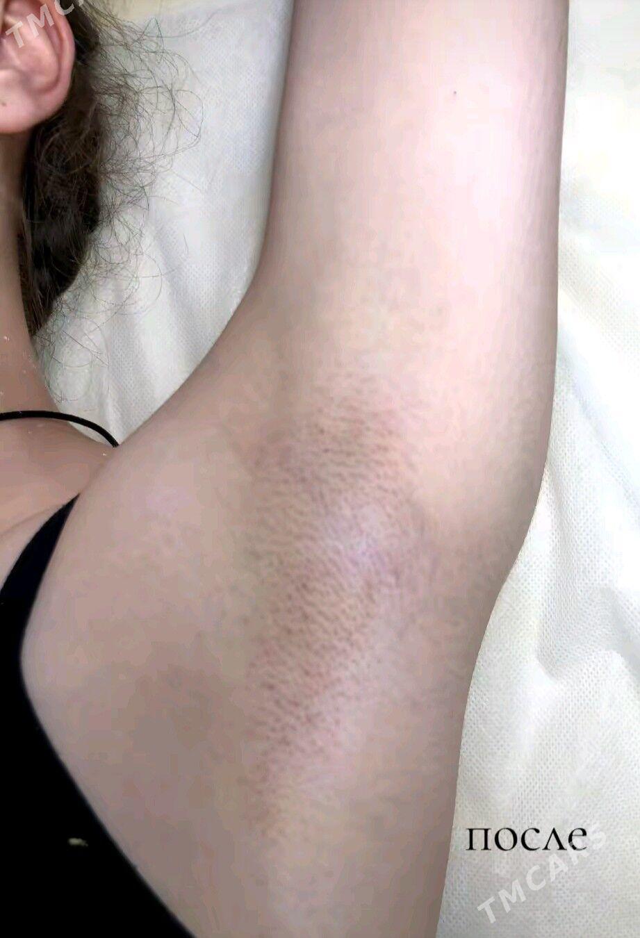 depilyasiya депиляция воском - Aşgabat - img 1