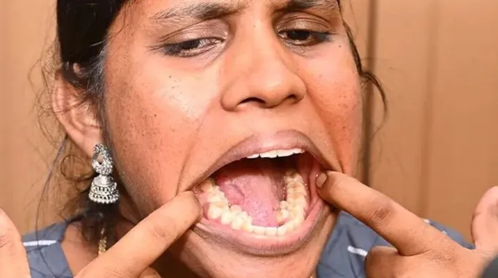 Жительница Индии с 38 зубами попала в Книгу рекордов Гиннесса