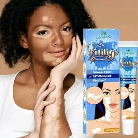 vitiligo deri krem