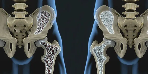 Исследователи открыли механизм самовосстановления костей