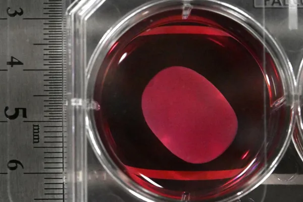 Ýaponiýada Parkinson keselini bejerýän ilkinji derman bölekleýin tassyklanyldy