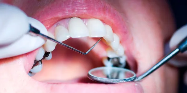 Stomatolog diş çüýremesiniň ötüşdirilmeginiň getirýän netijelerini düşündirdi