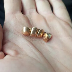 Gyzyl dis cysty